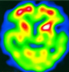 CT、SPECT、PET_ct,pet ,spect-CSDN博客