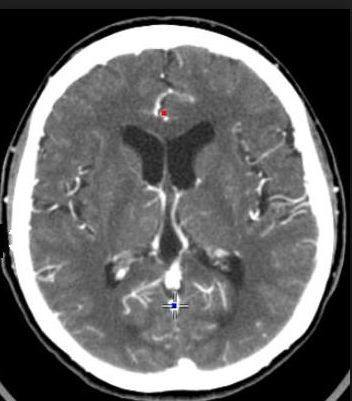 CT、SPECT、PET_ct,pet ,spect-CSDN博客
