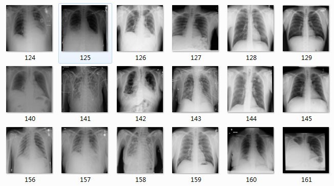 「肺炎 X 光病灶识别」挑战赛：几行代码，就能让医疗检测准确率 20% 的提高！