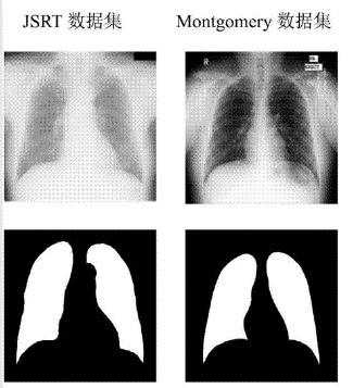 「肺炎 X 光病灶识别」挑战赛：几行代码，就能让医疗检测准确率 20% 的提高！